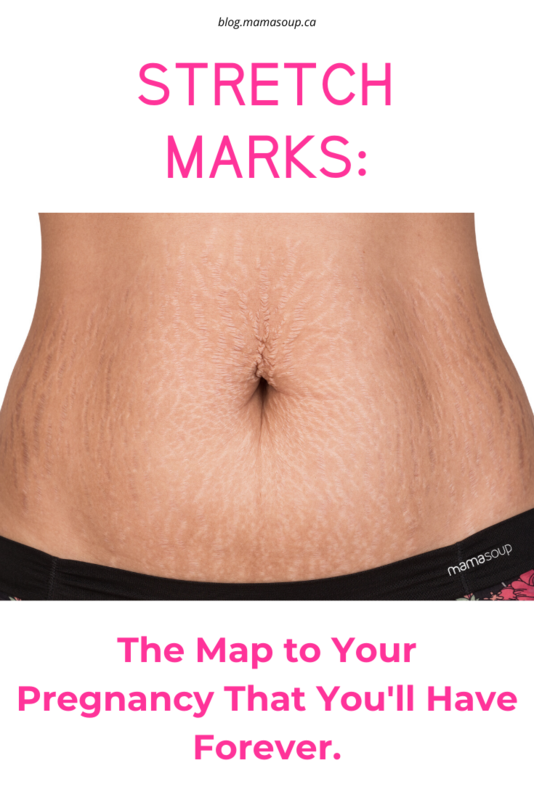 how to get rid of stretch marks